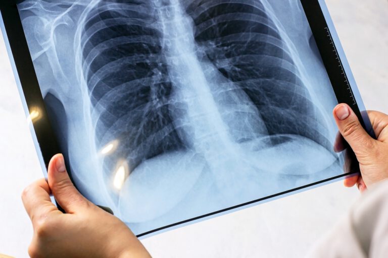 tuberculose