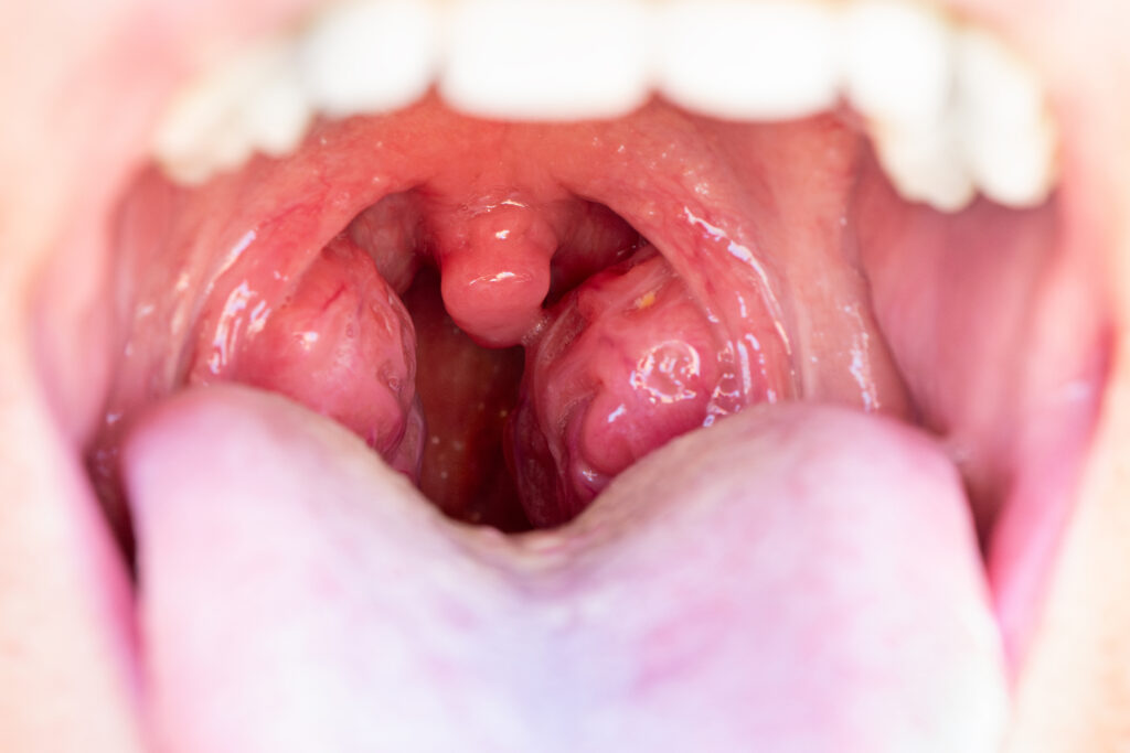 cirurgia para apneia do sono